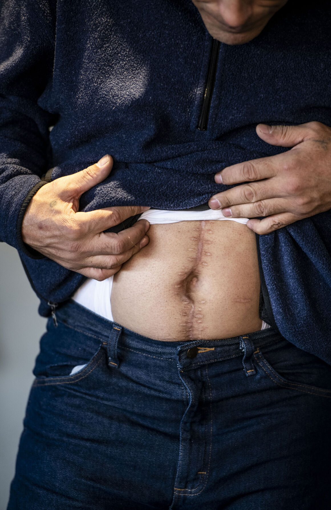Brian Puerta inspects scars he received from shooting in Huerfano County